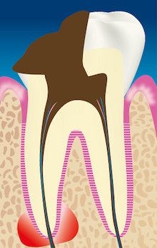 Abcès apical (= parodontite apicale aiguë)