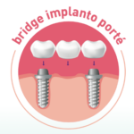 Bridge implanto-porté