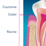 Collet dentaire
