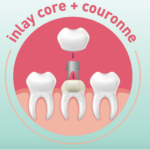 Couronne prothétique