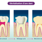 Endodontie/dévitalisation dentaire ou canalaire