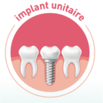 Implant dentaire