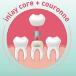 Inlay-core